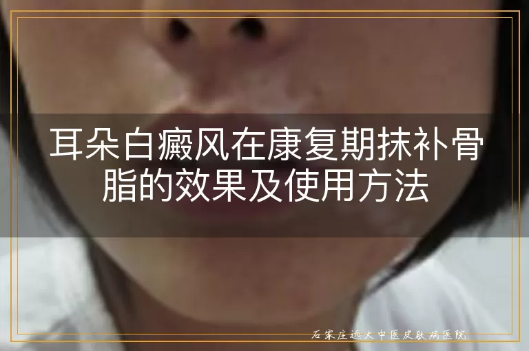 耳朵白癜风在康复期抹补骨脂的效果及使用方法