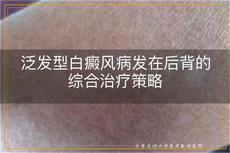 泛发型白癜风病发在后背的综合治疗策略