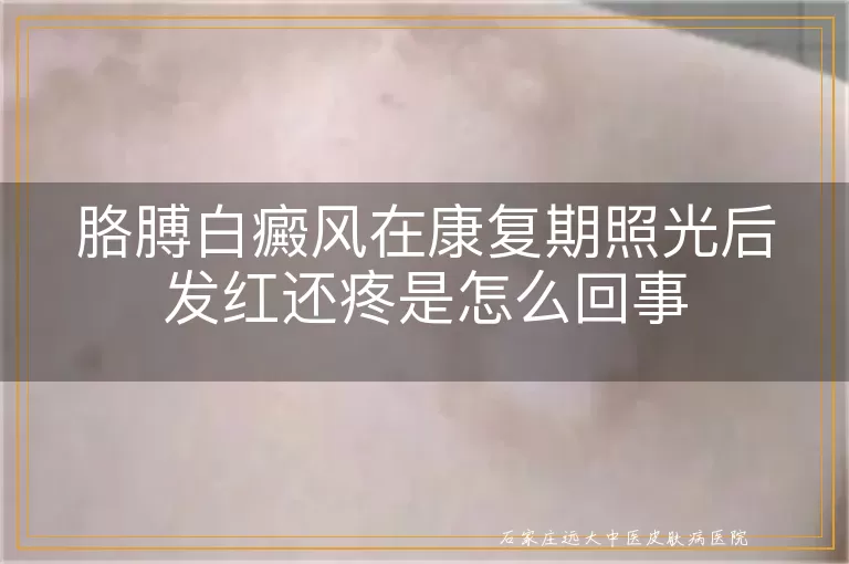 胳膊白癜风在康复期照光后发红还疼是怎么回事