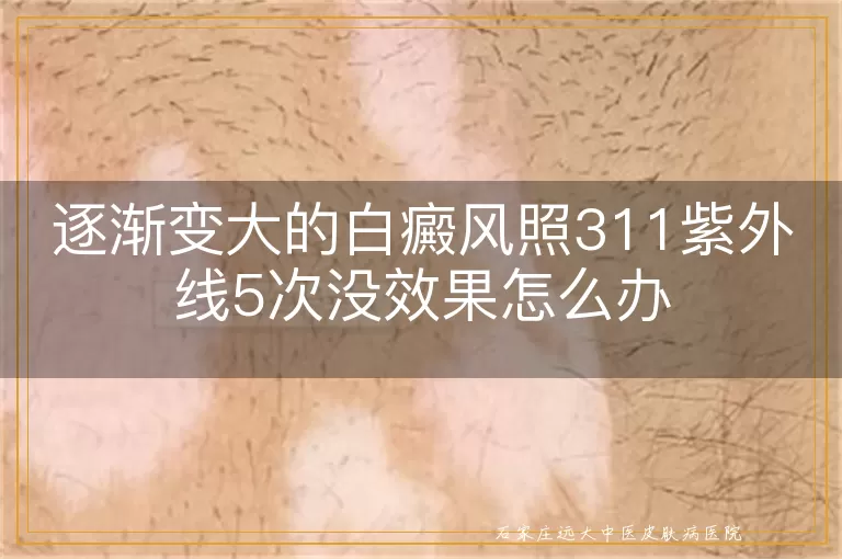 逐渐变大的白癜风照311紫外线5次没效果怎么办