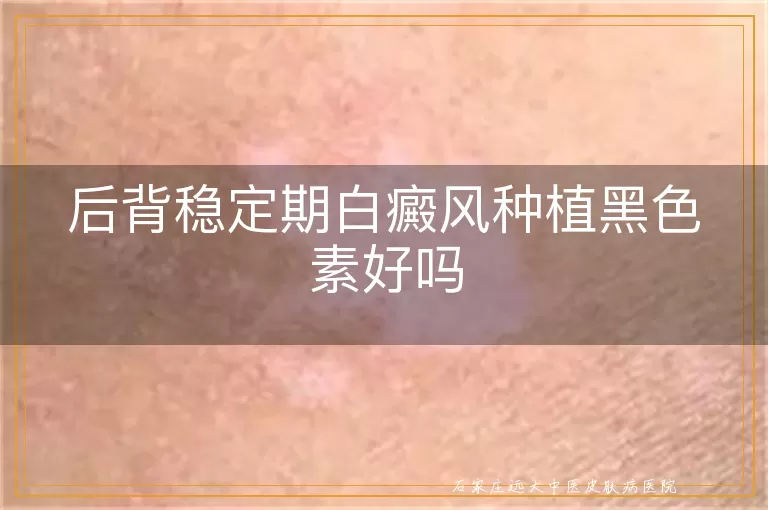 后背稳定期白癜风种植黑色素好吗