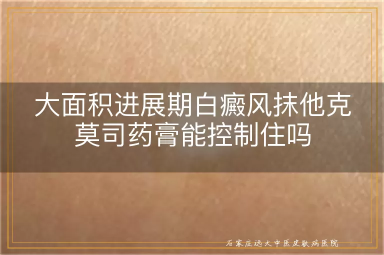 大面积进展期白癜风抹他克莫司药膏能控制住吗
