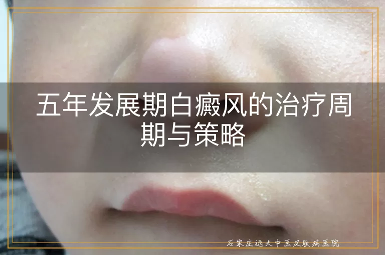 五年发展期白癜风的治疗周期与策略