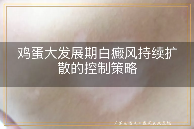 鸡蛋大发展期白癜风持续扩散的控制策略