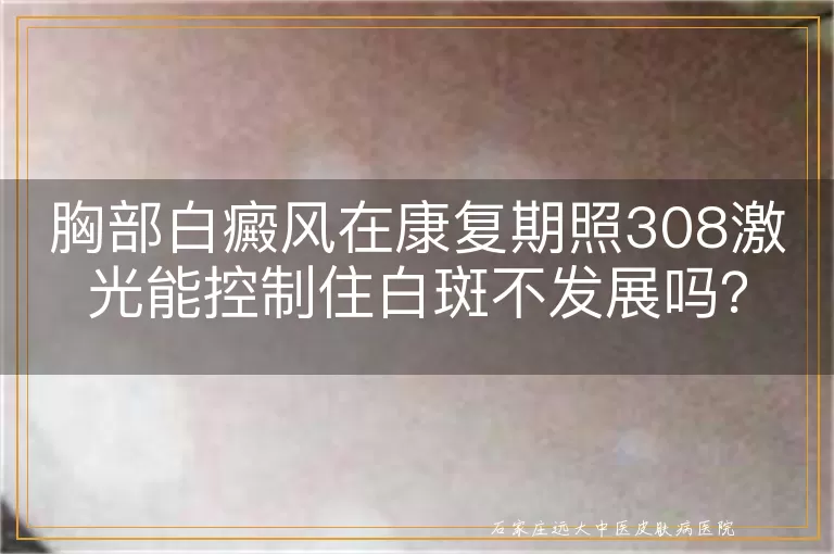 胸部白癜风在康复期照308激光能控制住白斑不发展吗？