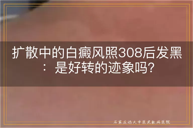 扩散中的白癜风照308后发黑：是好转的迹象吗？