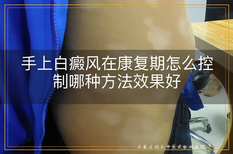 手上白癜风在康复期怎么控制哪种方法效果好