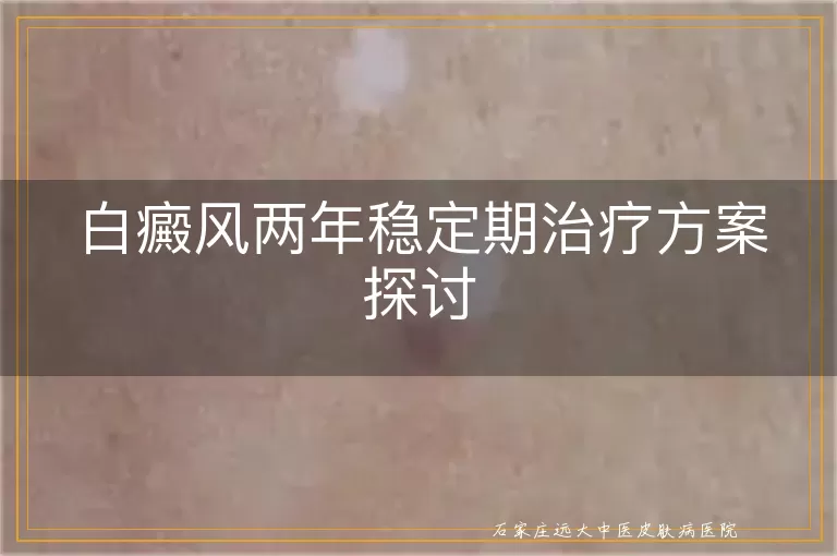 白癜风两年稳定期治疗方案探讨