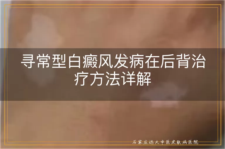 寻常型白癜风发病在后背治疗方法详解