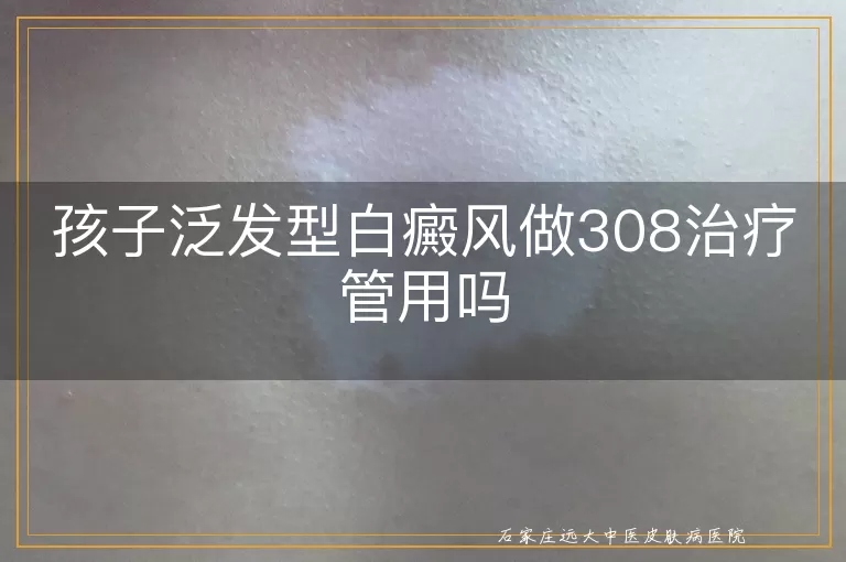 孩子泛发型白癜风做308治疗管用吗