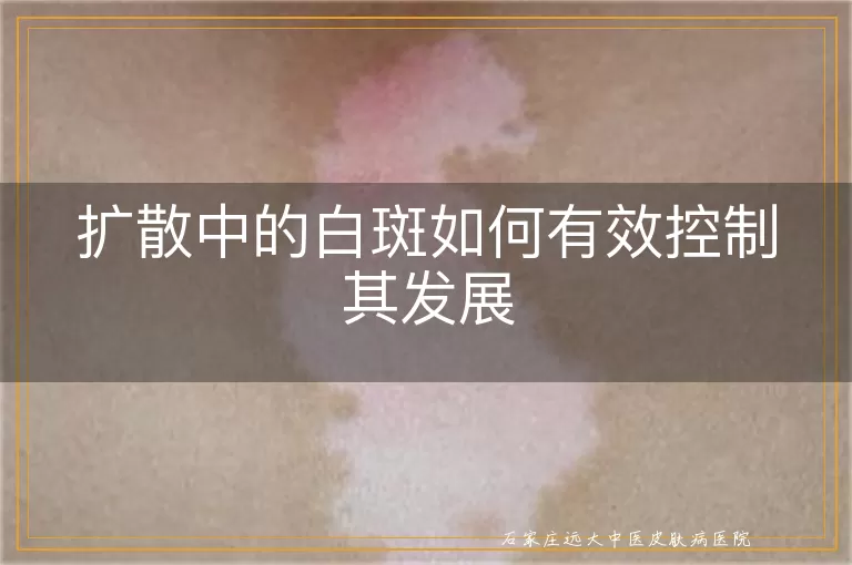 扩散中的白斑如何有效控制其发展