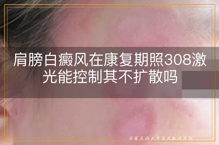 肩膀白癜风在康复期照308激光能控制其不扩散吗