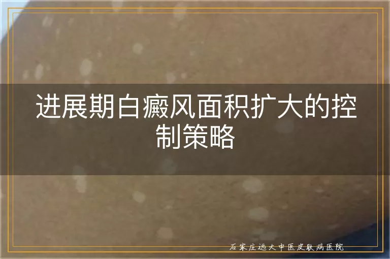 进展期白癜风面积扩大的控制策略