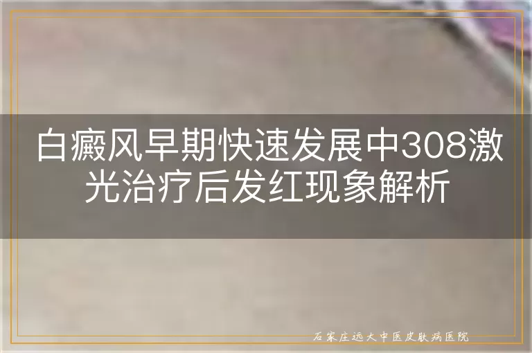 白癜风早期快速发展中308激光治疗后发红现象解析