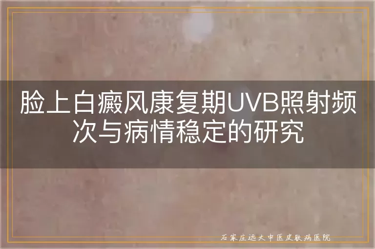 脸上白癜风康复期UVB照射频次与病情稳定的研究