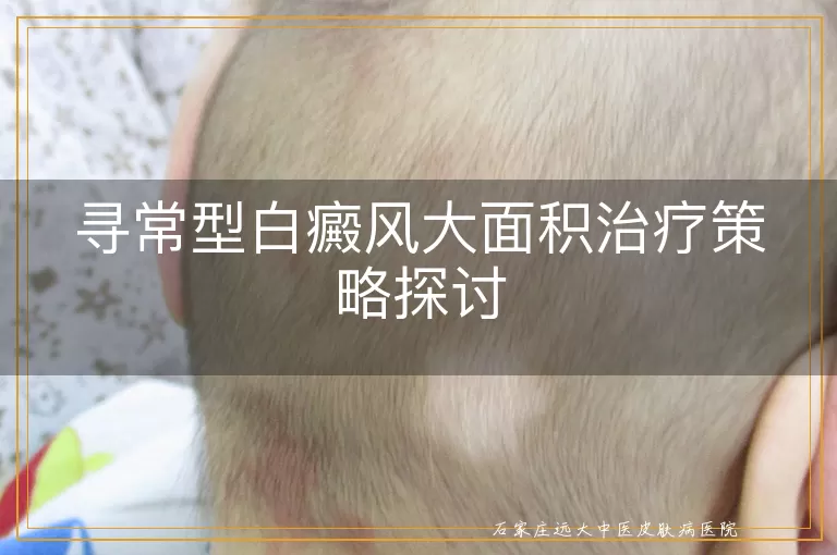 寻常型白癜风大面积治疗策略探讨