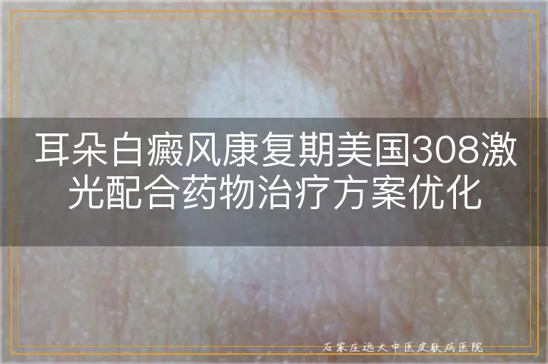耳朵白癜风康复期美国308激光配合药物治疗方案优化