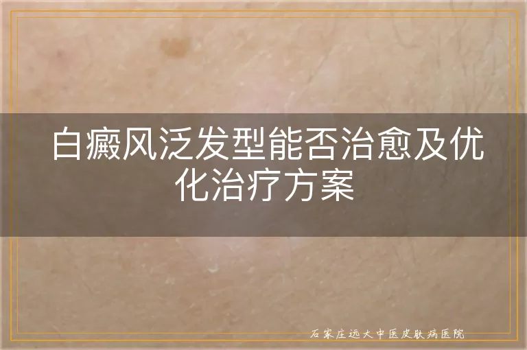 白癜风泛发型能否治愈及优化治疗方案