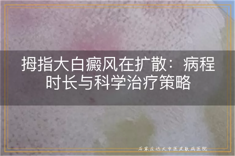 拇指大白癜风在扩散：病程时长与科学治疗策略