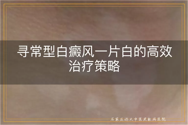 寻常型白癜风一片白的高效治疗策略