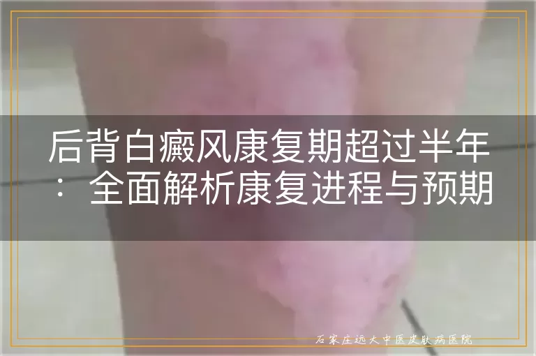 后背白癜风康复期超过半年：全面解析康复进程与预期