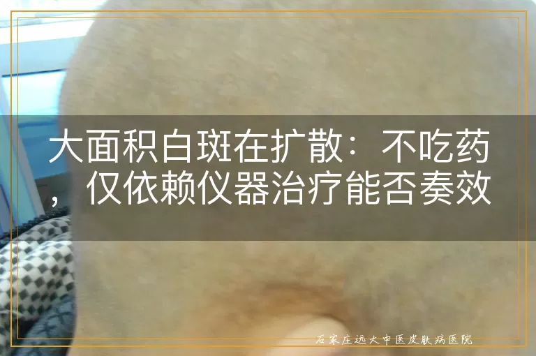 大面积白斑在扩散：不吃药，仅依赖仪器治疗能否奏效？