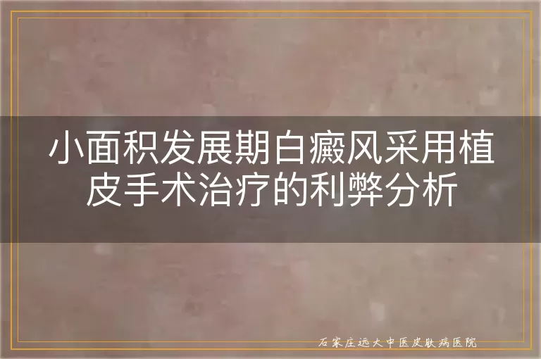 小面积发展期白癜风采用植皮手术治疗的利弊分析