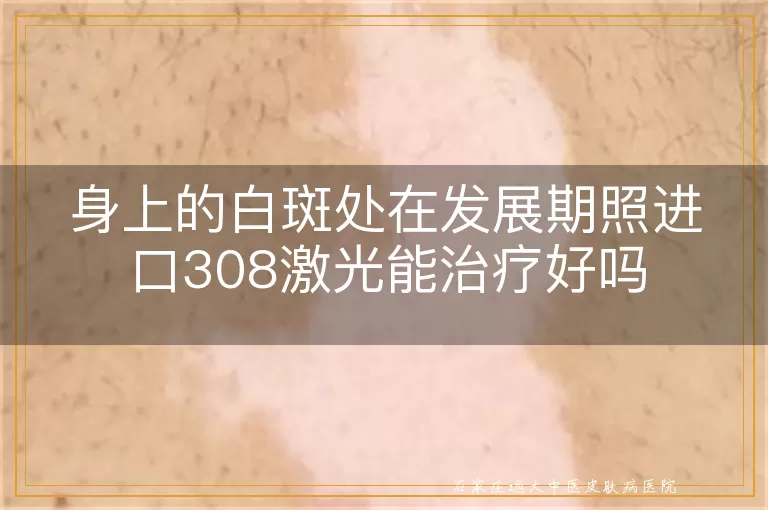 身上的白斑处在发展期照进口308激光能治疗好吗