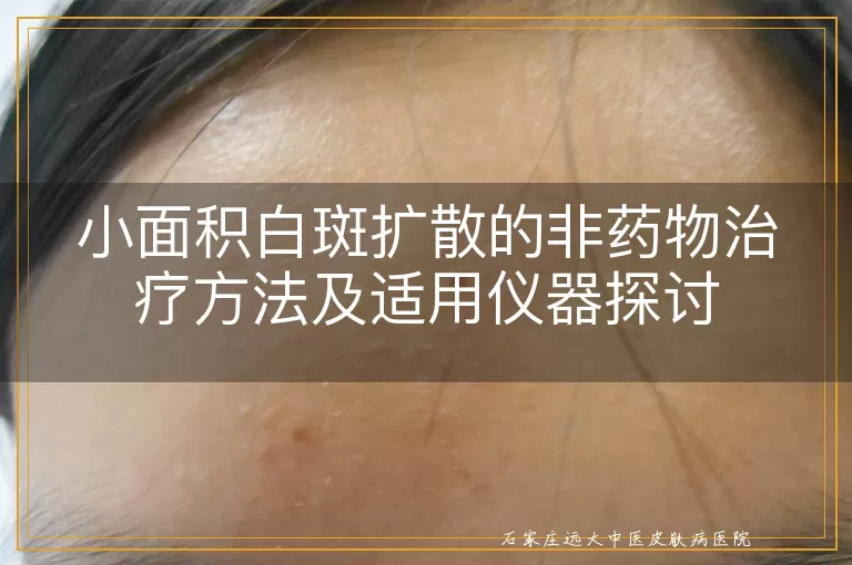 小面积白斑扩散的非药物治疗方法及适用仪器探讨
