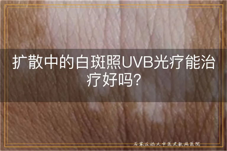 扩散中的白斑照UVB光疗能治疗好吗？