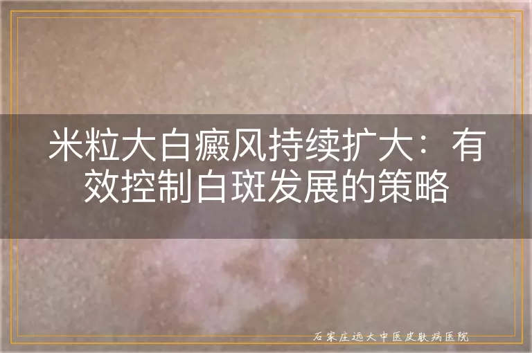 米粒大白癜风持续扩大：有效控制白斑发展的策略