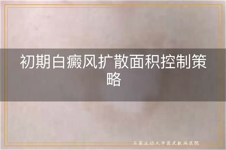 初期白癜风扩散面积控制策略