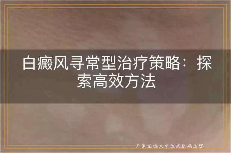 白癜风寻常型治疗策略：探索高效方法