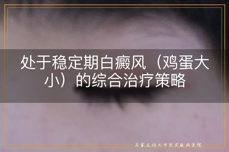 处于稳定期白癜风（鸡蛋大小）的综合治疗策略