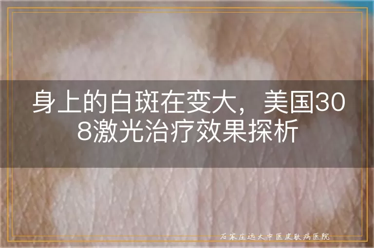 身上的白斑在变大，美国308激光治疗效果探析
