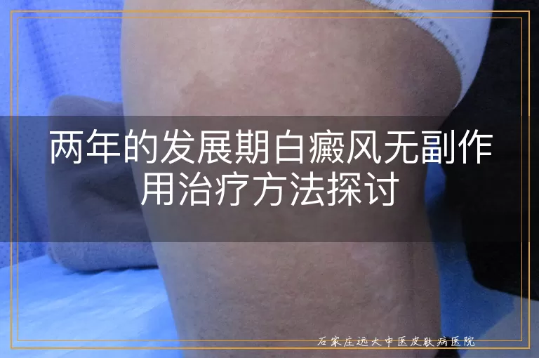 两年的发展期白癜风无副作用治疗方法探讨
