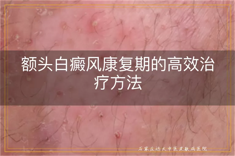 额头白癜风康复期的高效治疗方法