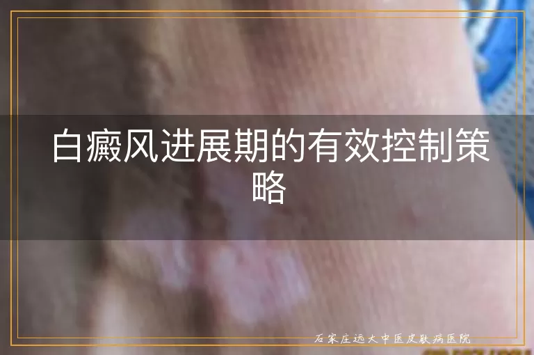 白癜风进展期的有效控制策略