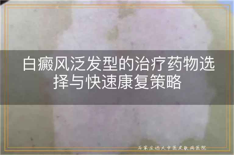 白癜风泛发型的治疗药物选择与快速康复策略
