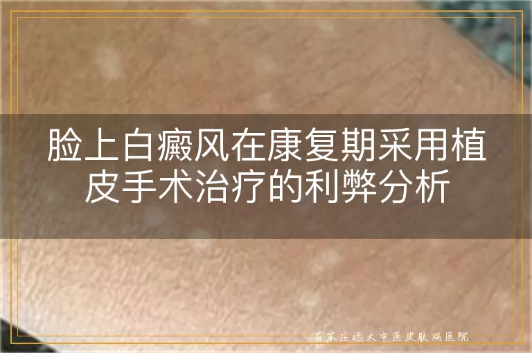 脸上白癜风在康复期采用植皮手术治疗的利弊分析
