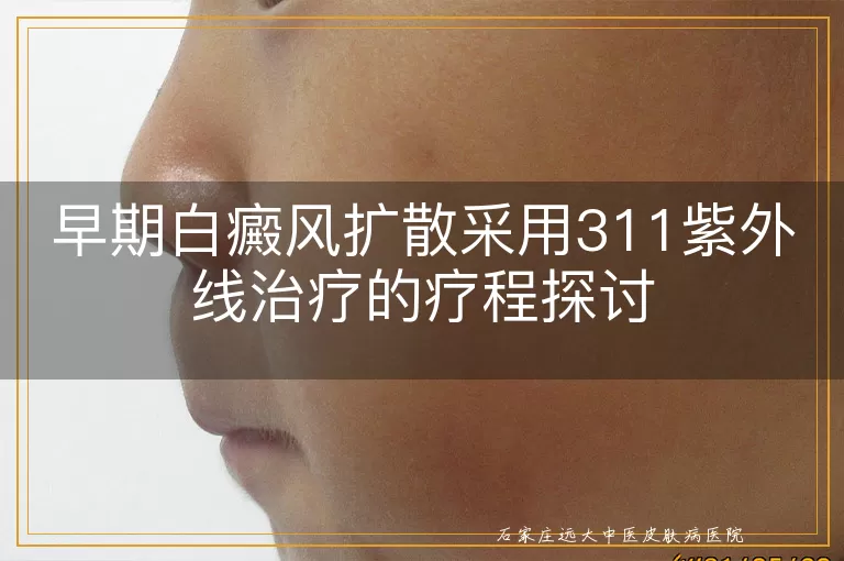早期白癜风扩散采用311紫外线治疗的疗程探讨