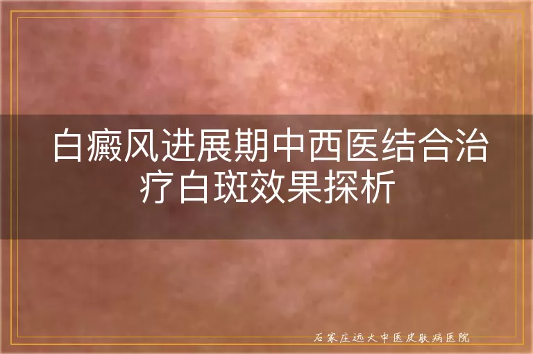 白癜风进展期中西医结合治疗白斑效果探析