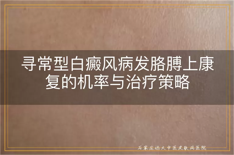 寻常型白癜风病发胳膊上康复的机率与治疗策略