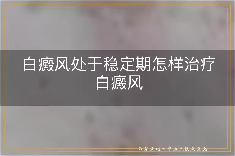 白癜风处于稳定期怎样治疗白癜风