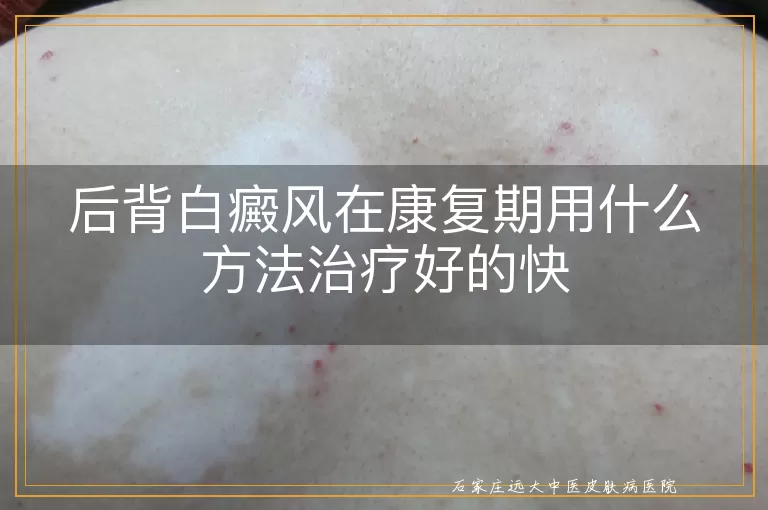 后背白癜风在康复期用什么方法治疗好的快
