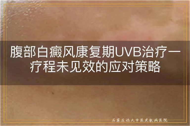 腹部白癜风康复期UVB治疗一疗程未见效的应对策略