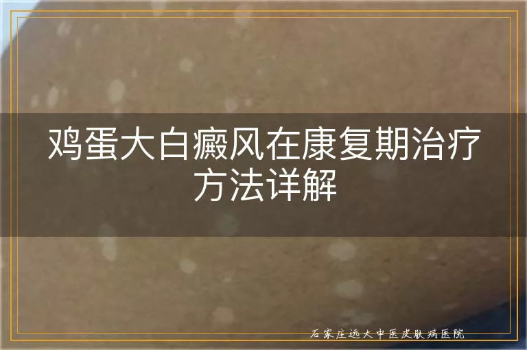 鸡蛋大白癜风在康复期治疗方法详解
