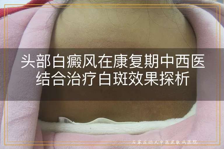 头部白癜风在康复期中西医结合治疗白斑效果探析