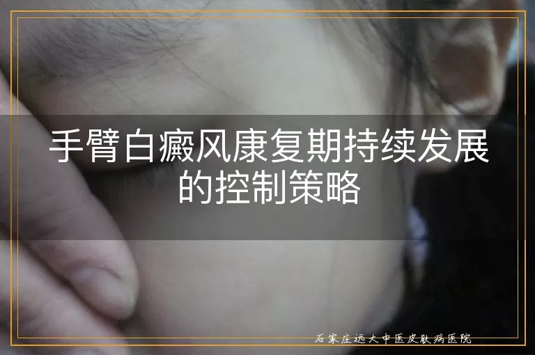 手臂白癜风康复期持续发展的控制策略