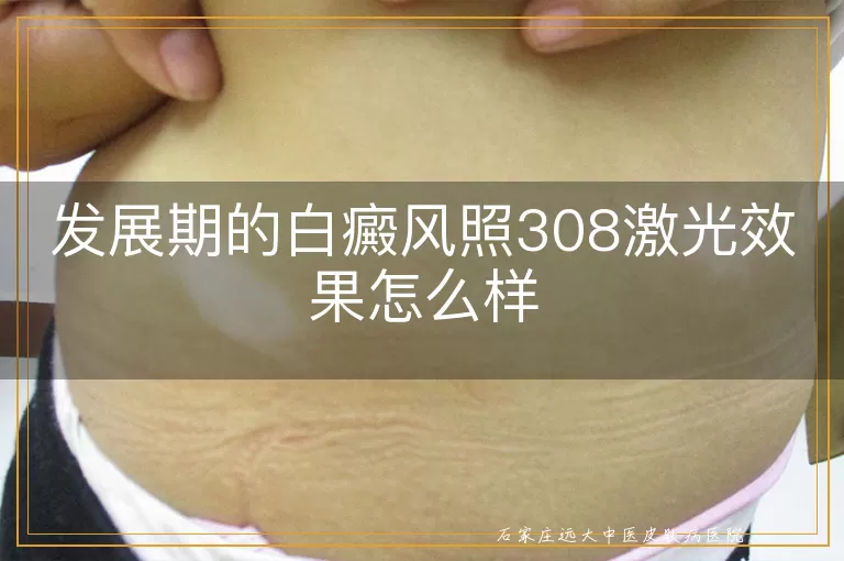 发展期的白癜风照308激光效果怎么样